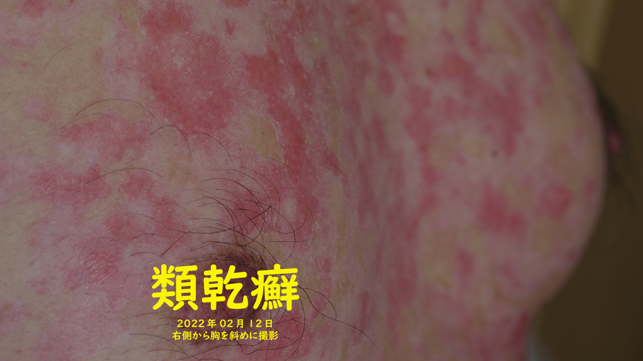 類乾癬、イヤだー