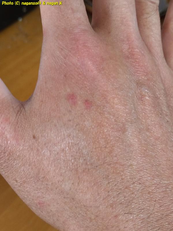 スズキの背びれで手の甲を突かれて負傷している。|泉佐野市「なが~ン」氏自宅。2024年04月12日撮影