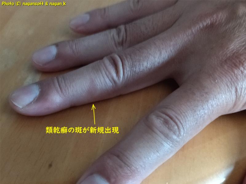 右手中指に類乾癬の班が出現