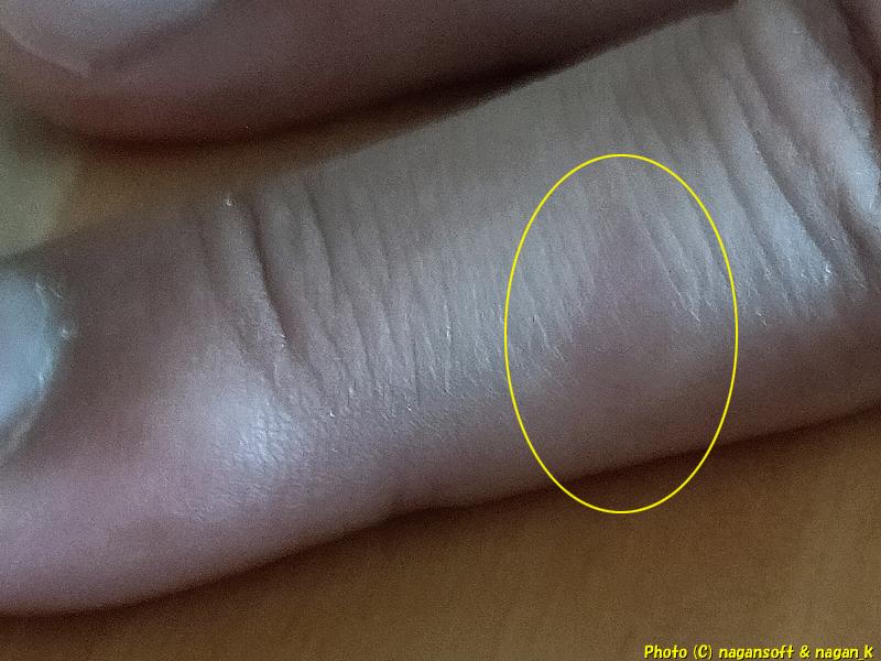 右手中指に類乾癬の班が出現(拡大)