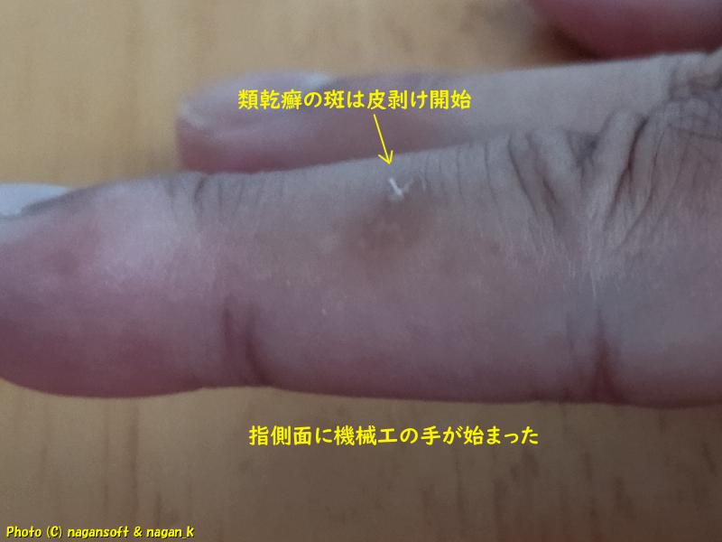 右手中指の類乾癬。指側面に機械工の手
