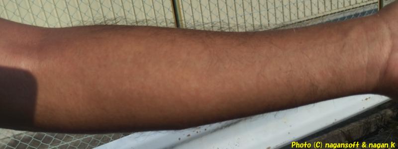 類乾癬です。斑肌の左腕。