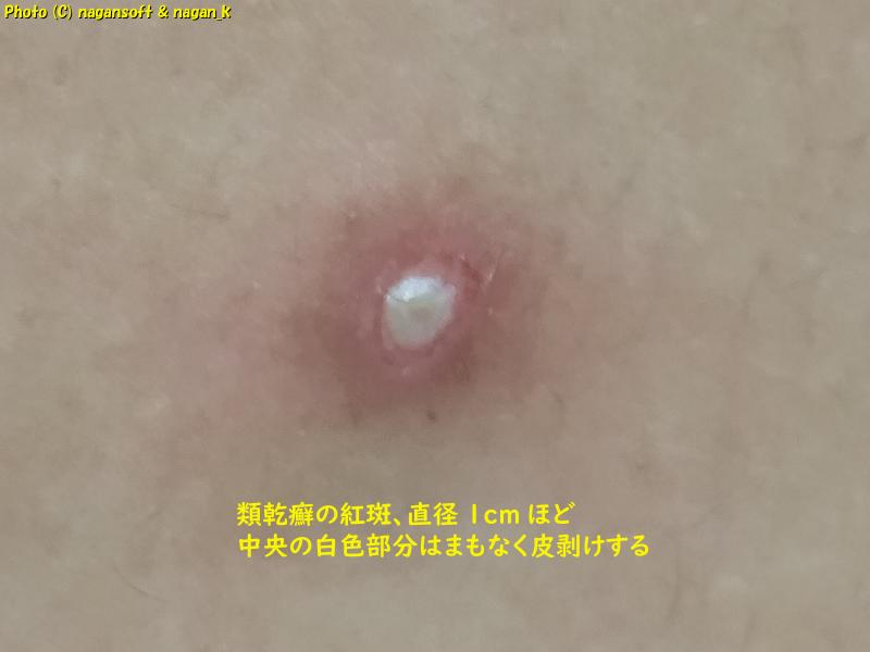 直径1cmほどの類乾癬紅斑。皮剥け間近の状態。