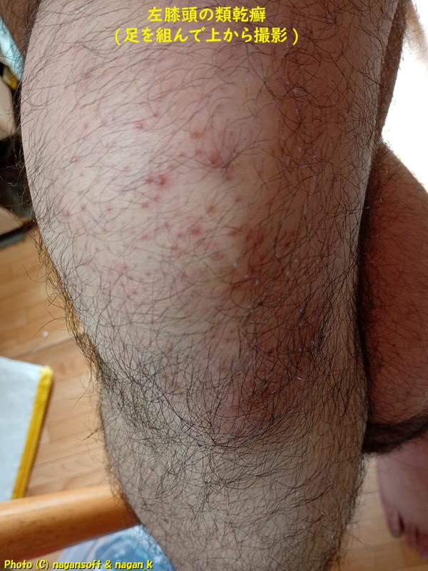 左膝頭の類乾癬