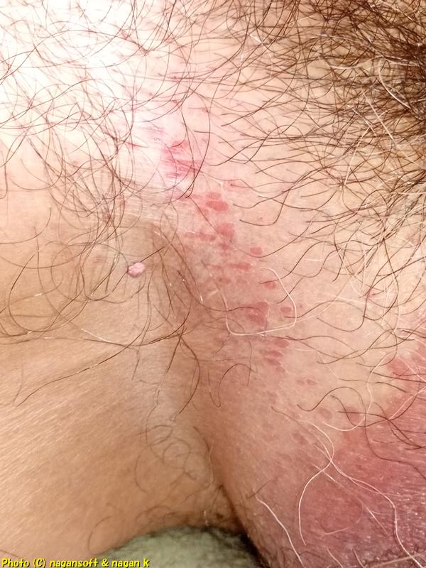 鼠径部に出現した類乾癬(右鼠径部)、2025年12月06日撮影