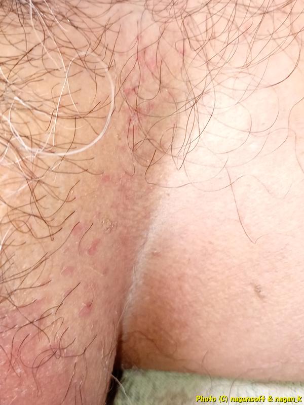 鼠径部に出現した類乾癬(左鼠径部)、2025年12月06日撮影