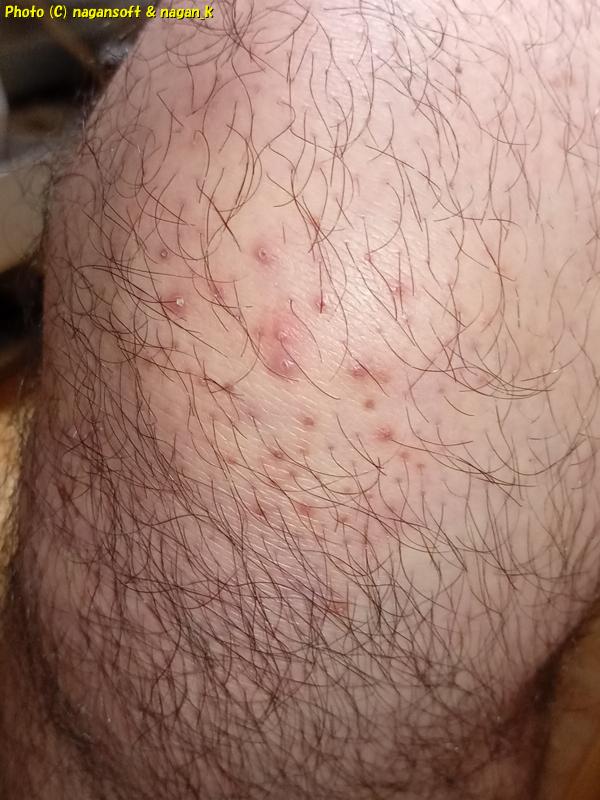 膝頭に大量に出現しはじめている毛包炎、類乾癬、2025年12月06日撮影