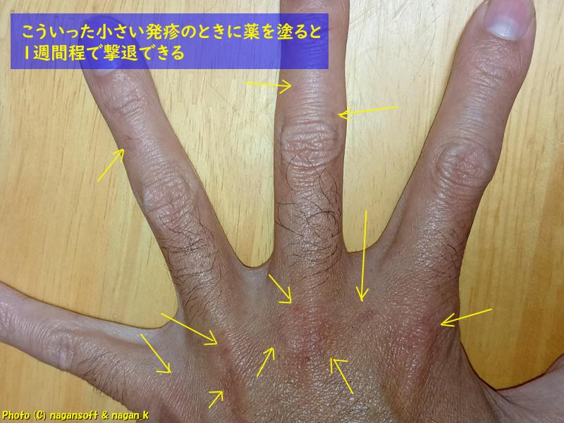 手の甲側に出現しはじめている小さい類乾癬、2025年12月27日撮影
