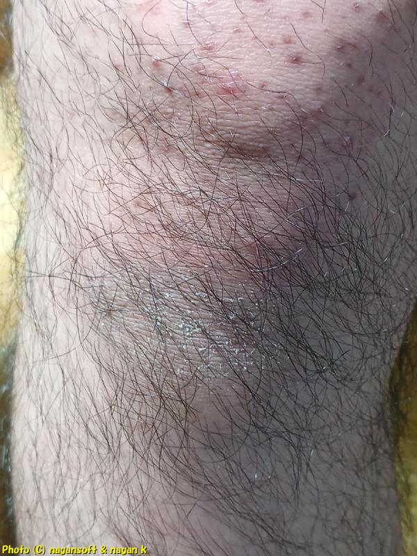 右膝頭の毛包炎とその下部は皮膚が固く皮が剥けている、類乾癬、2026年01月04日撮影