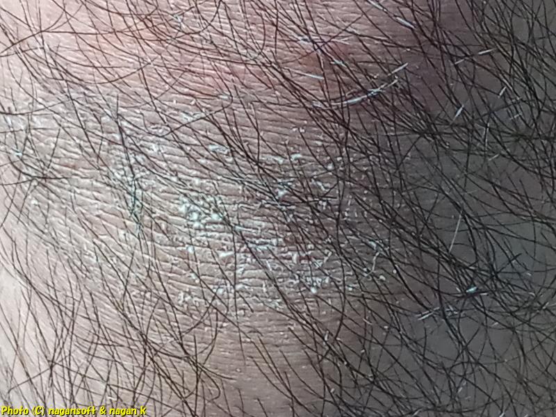 右膝頭の下部に広がっている皮が剥けている箇所を拡大、類乾癬、2026年01月04日撮影