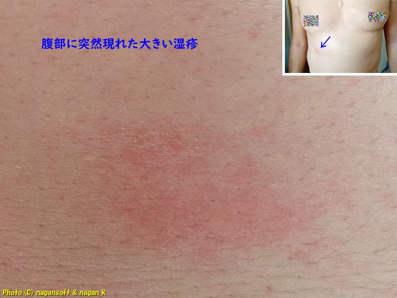 右下腹部に突然大きめの湿疹が出現する。類乾癬の発疹大量発生開始の始まりではないかと用心する、類乾癬、2026年01月17日撮影