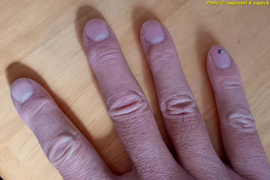 指全体の皮剥けが始まる、小さい類乾癬の発疹が出現しようとしている。2026年01月31日撮影