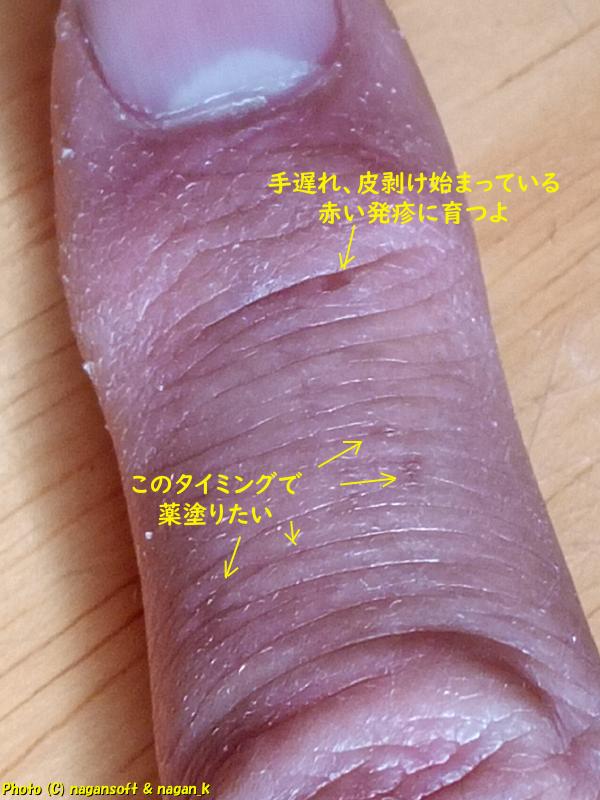 指全体の皮剥けと小さい類乾癬の発疹を拡大撮影、2026年01月31日撮影