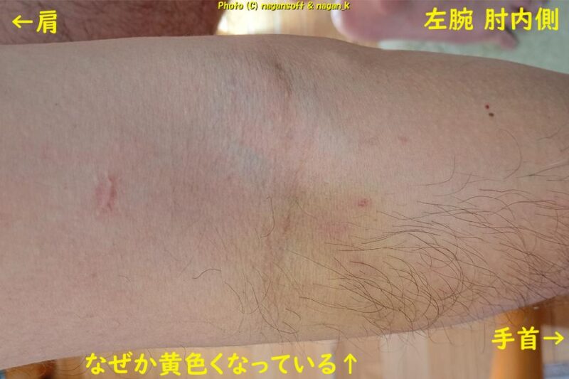 左腕肘内側に黄色いアザが浮き上がる|類乾癬治療|2026年03月05日撮影