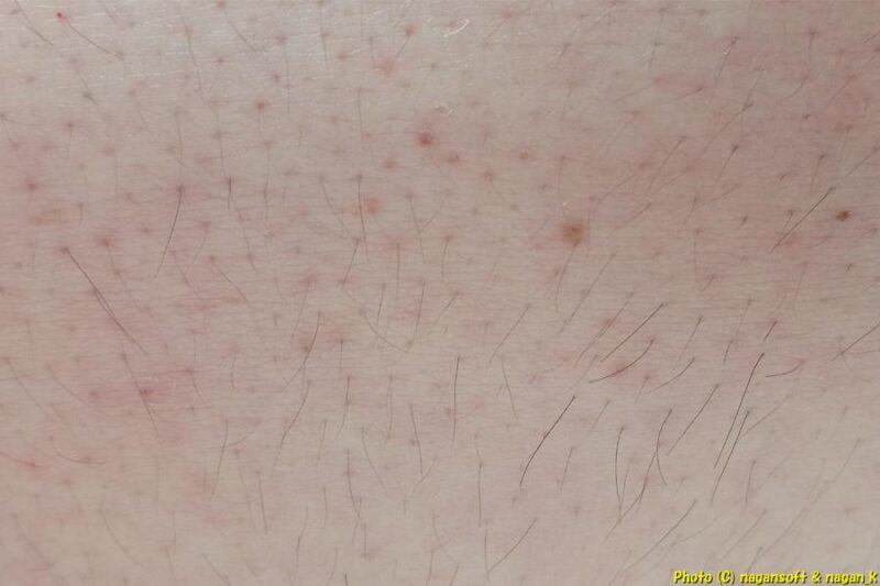 お腹に毛包炎が出現、その毛包炎周辺に皮剥け出現、類乾癬紅斑のきっかけと思われる|類乾癬治療|2026年03月07日撮影