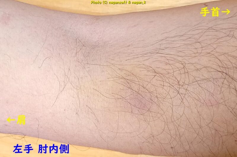 左腕肘内側に黄色いアザ部分がうろこ状の皮膚に変化する|類乾癬治療|2026年03月07日撮影