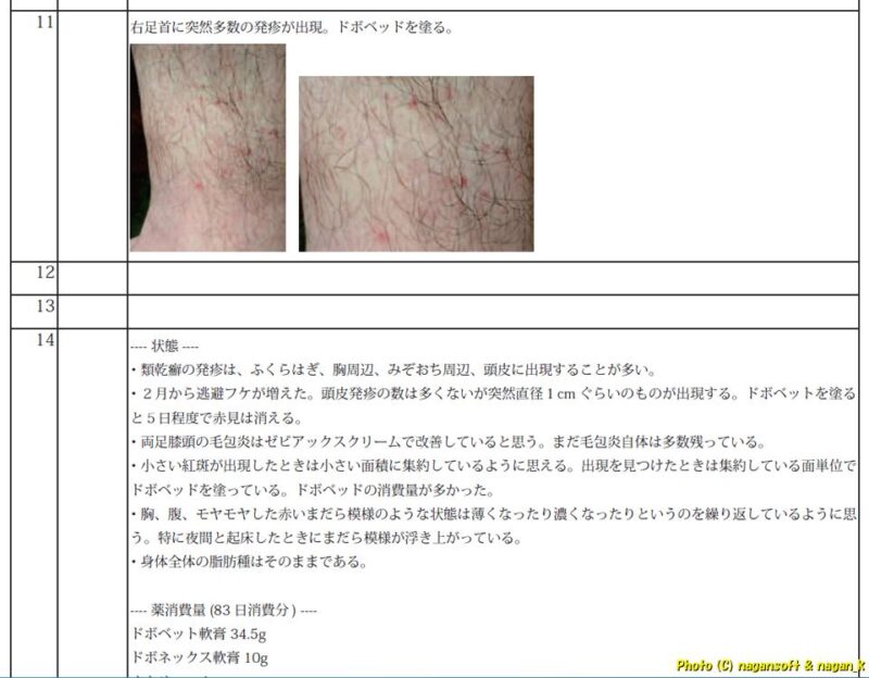大病院の主治医へ提出するレポート(抜粋)|類乾癬治療|2026年04月14日撮影