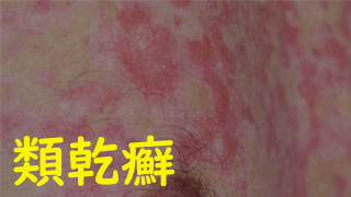 類乾癬、尋常性乾癬